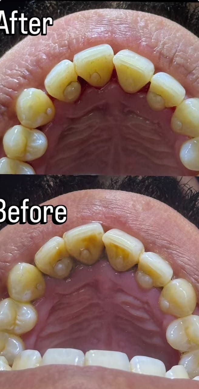 Dental Cleaning & Stain Removal - Before and After